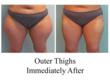 Amazing liposuction results